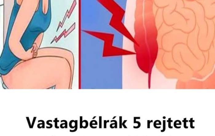 Vastagbélrák 5 rejtett tünete, amit jobb, ha ismersz!